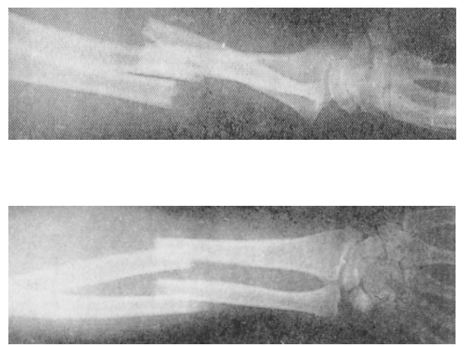 Fractures | Homework Help | Assignment Help | Bones and Joints